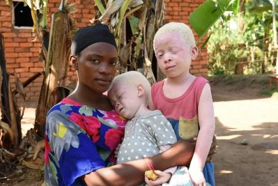 Faith, Aisha e Akram Faith è una donna ugandese i cui due figli, Aisha e Akram, sono bimbi con albinismo. Alla loro nascita il padre ha abbandonato la famiglia e la comunità ha isolato Faith e i bambini stessi, indicandoli come “il frutto di una maledizione”