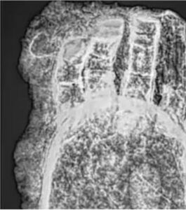 Radiografia della protesi alla mano scoperta vicino a Monaco di Baviera, in Germania, risalente a quasi 600 anni fa (fonte: «Focus»).